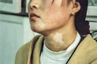 武汉女性局限型白斑病因有哪些?