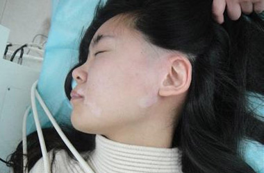武汉哪些原因会使女性白斑病发呢?