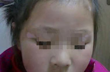 武汉儿童白斑预防时应该注意哪些地方呢？