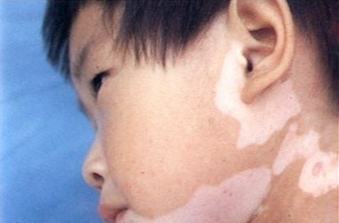 武汉儿童患上白斑应该怎么做呢？