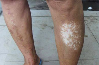 武汉有哪些因素会影响到腿部白斑的治疗呢?