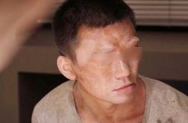 武汉男性白斑患者在生活中该怎样做才是正确的护理?