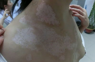 武汉女性胸部白斑护理该怎么做好呢? 