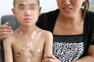 武汉白斑医院：如何防止儿童白斑复发