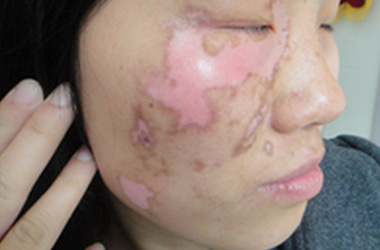 武汉白斑医院医生讲解预防脸部患白斑的措施