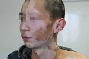武汉白斑医院：男性患白斑的危害有哪些