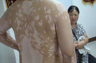 武汉白斑医院：男性患白斑的危害有哪些
