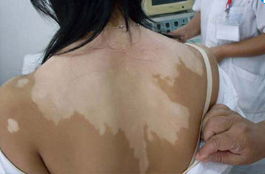 武汉白斑医院：背部出现白斑的原因有哪些呢