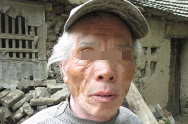 武汉白斑医院：中老年人是怎么患上白斑的呢