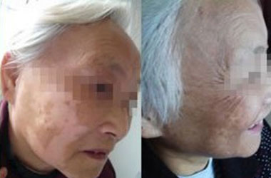 武汉白斑医院：中老年人是怎么患上白斑的呢