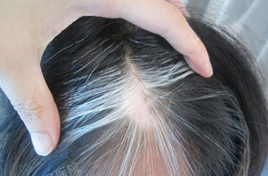 武汉白斑医院：染头发对女性头部白斑有影响没