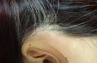 武汉白斑医院：染头发对女性头部白斑有影响没