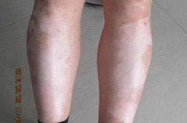 武汉预防女性腿部白斑措施有哪些么