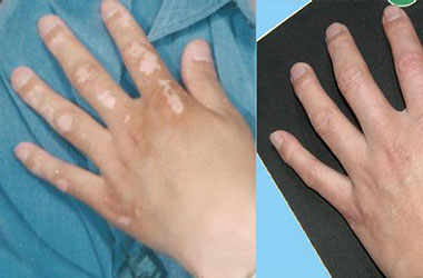 武汉白斑医院：手部白斑的病因是什么