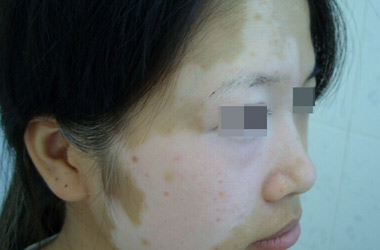 武汉白斑医院：面部白斑的几大危害