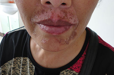 武汉白斑医院：面部白斑的几大危害