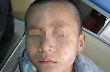 武汉白斑医院：外伤是怎么诱发儿童白斑的