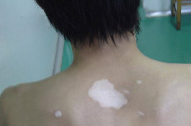 武汉白斑医院医生讲解背部白斑的早期症状