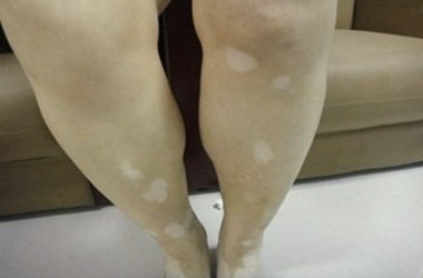 武汉白斑医院医生介绍腿部白斑的症状特点