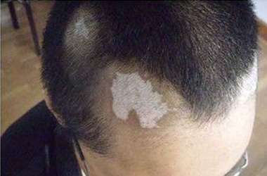 武汉男性白斑患者该怎样保养自己的皮肤呢?