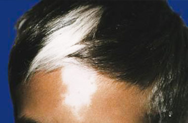 武汉白斑医院：头部病发白斑会出现脱发吗