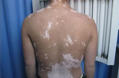 武汉专业治疗白斑的医院讲解泛发型白斑症状