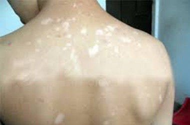 武汉白斑医院：背部白斑反复发作的原因是什么
