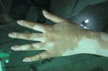 武汉治疗白斑医院讲解手部白斑的症状表现