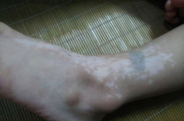 武汉白斑专科医院讲解脚部白斑的症状表现