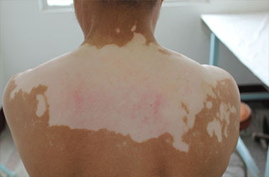 武汉白斑医院讲解背部白斑的护理常识有哪些