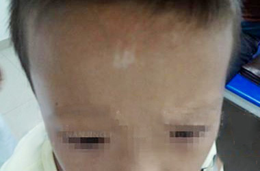 武汉白斑专科医院：儿童白斑早期如何识别呢?