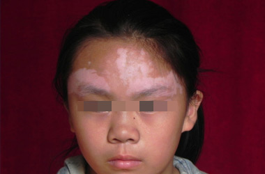 武汉白斑专科医院：儿童白斑早期如何识别呢?