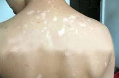 武汉白斑医院：散发型白斑有哪些症状特点?