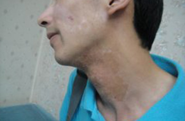 脖子上的白癜风症状是什么样的呢?
